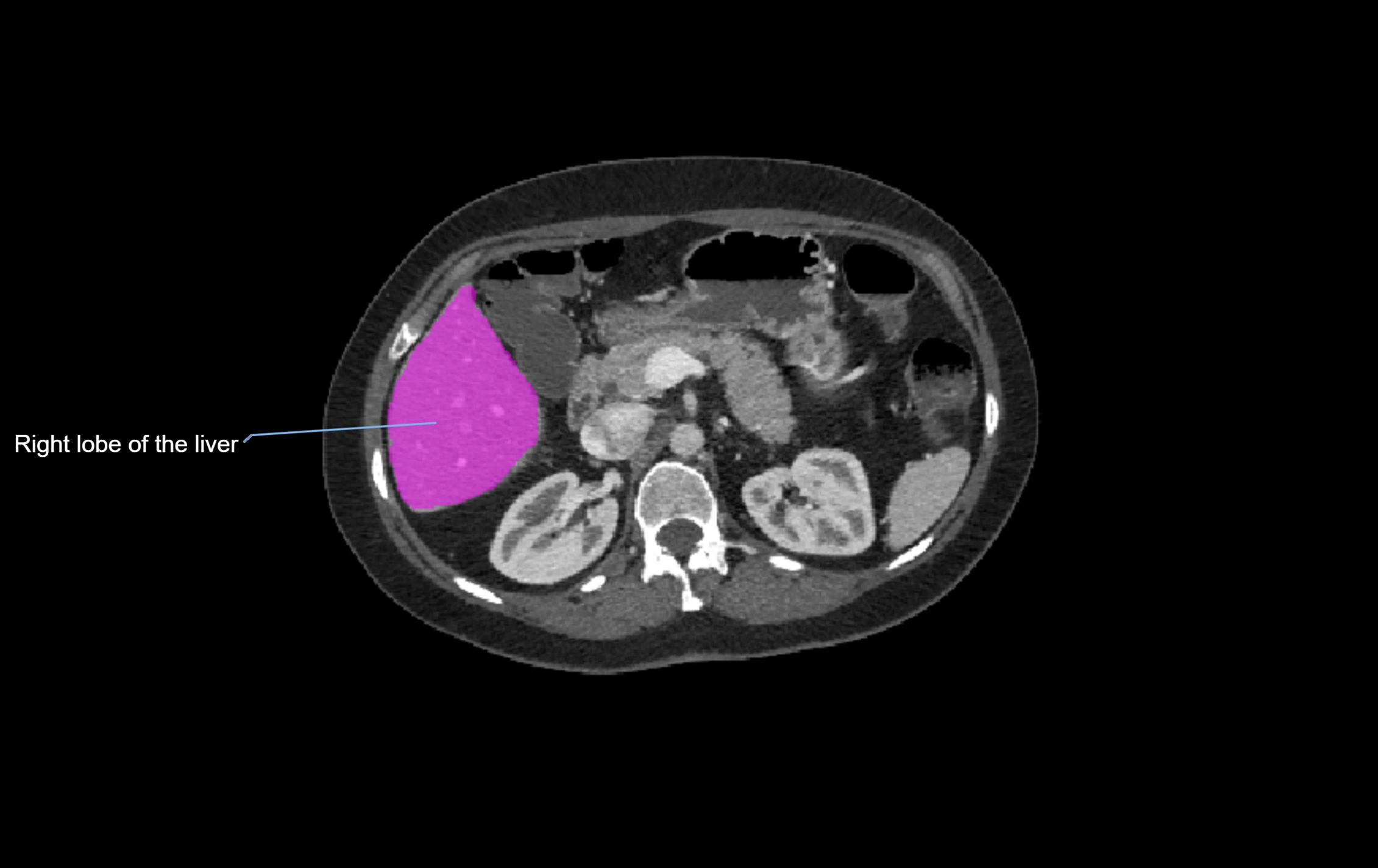 CT lliver lobes axial cross sectional anatomy labelled image -00033.webp